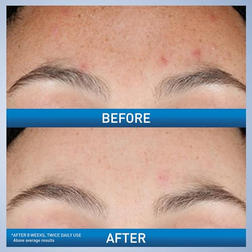 Pore Minimizer