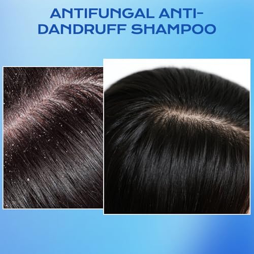 1% Ketoconazole Anti-Dandruff Shampoo