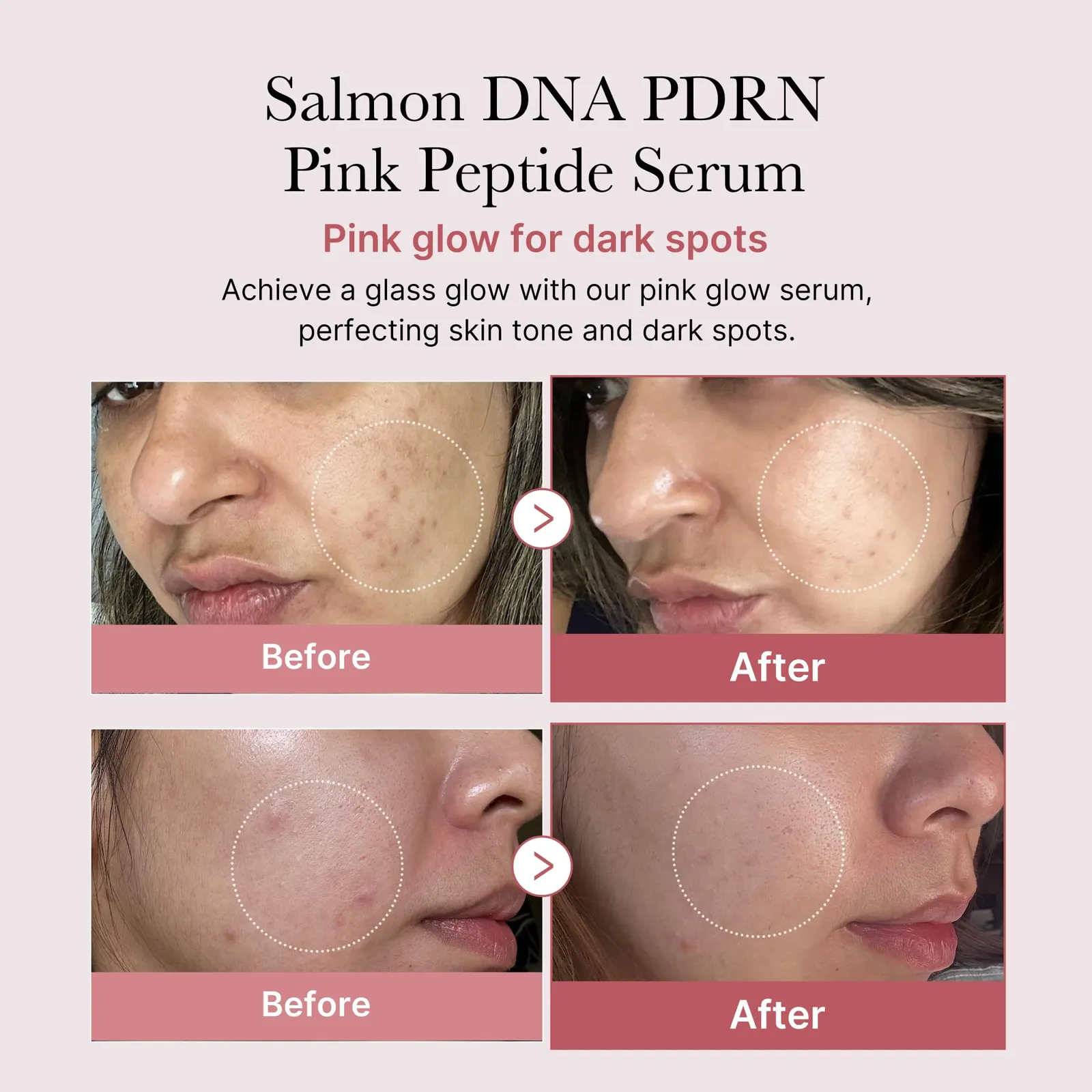 Zero Pore Pads & Salmon Serum