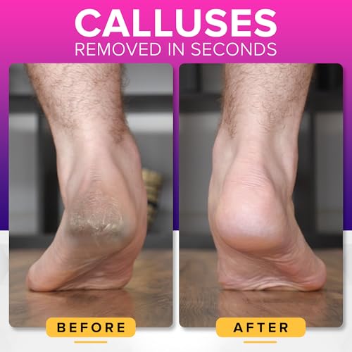 RUSTPROOF Foot File Callus Remover for Feet with Catcher | XL Size