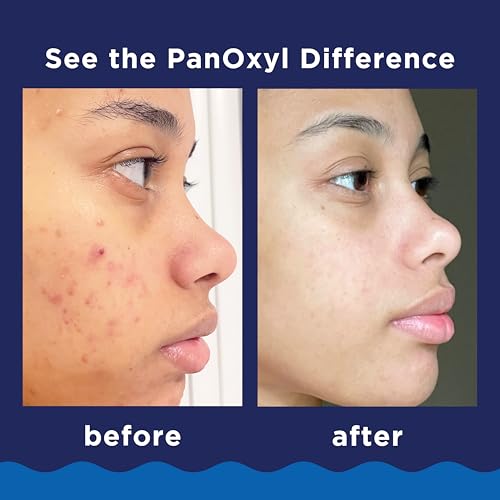 Acne Foaming Wash, 10% Benzoyl Peroxide, For Face & Body