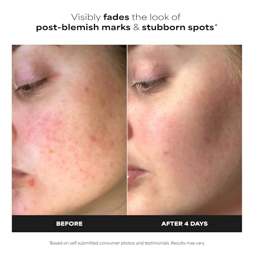 BOOST 10% Azelaic Acid Booster Cream Gel