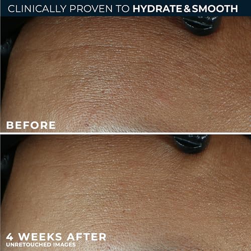 Hyaluronic Acid