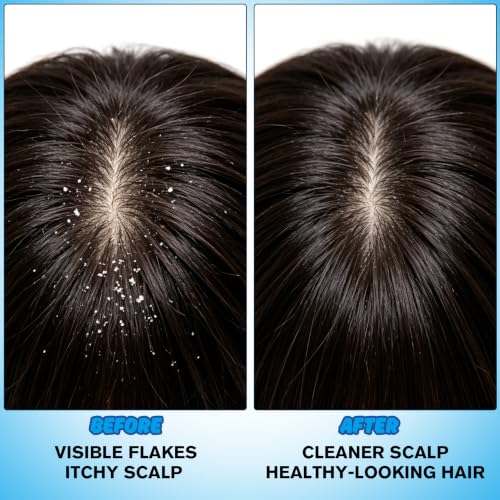 1% Ketoconazole Anti-Dandruff Shampoo
