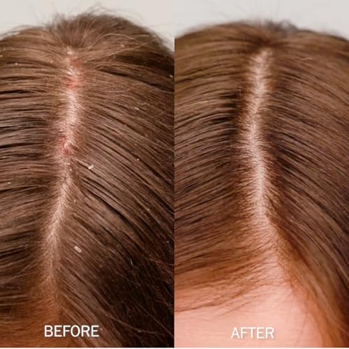 Scalp Shampoo, Anti-Dandruff, Itchy Dry Scalp Relief