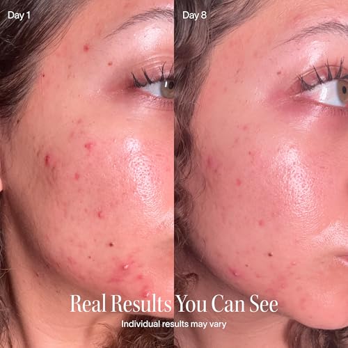 Bye Acne - FDA-Cleared Blue & Red Light Therapy for Face & Body