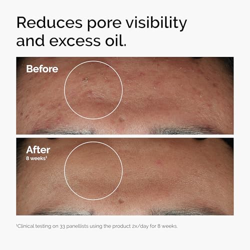 Smoothing Serum for Blemish-Prone Skin