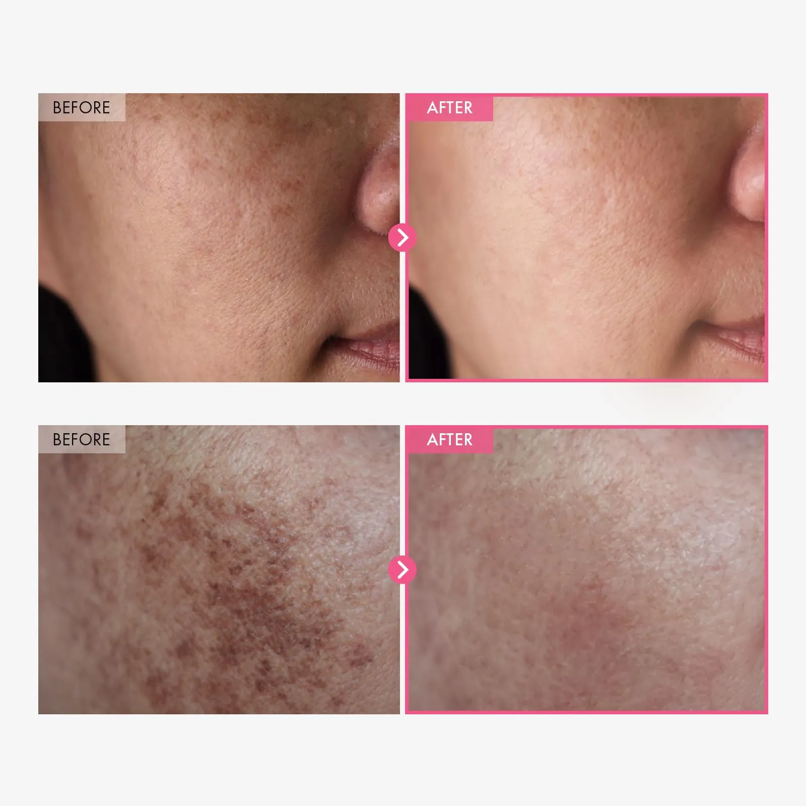Arbutin + Tranexamic Acid Cream