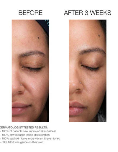 Accelerated Aesthetics Lactic Acid Retexturing Micro-Peel