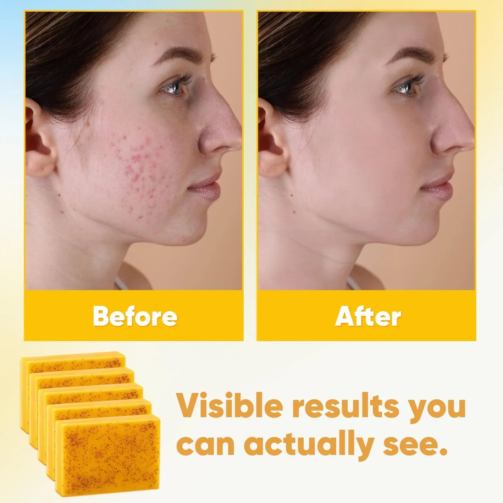 Treeroot Turmeric & Kojic Acid Soap 5-Pack