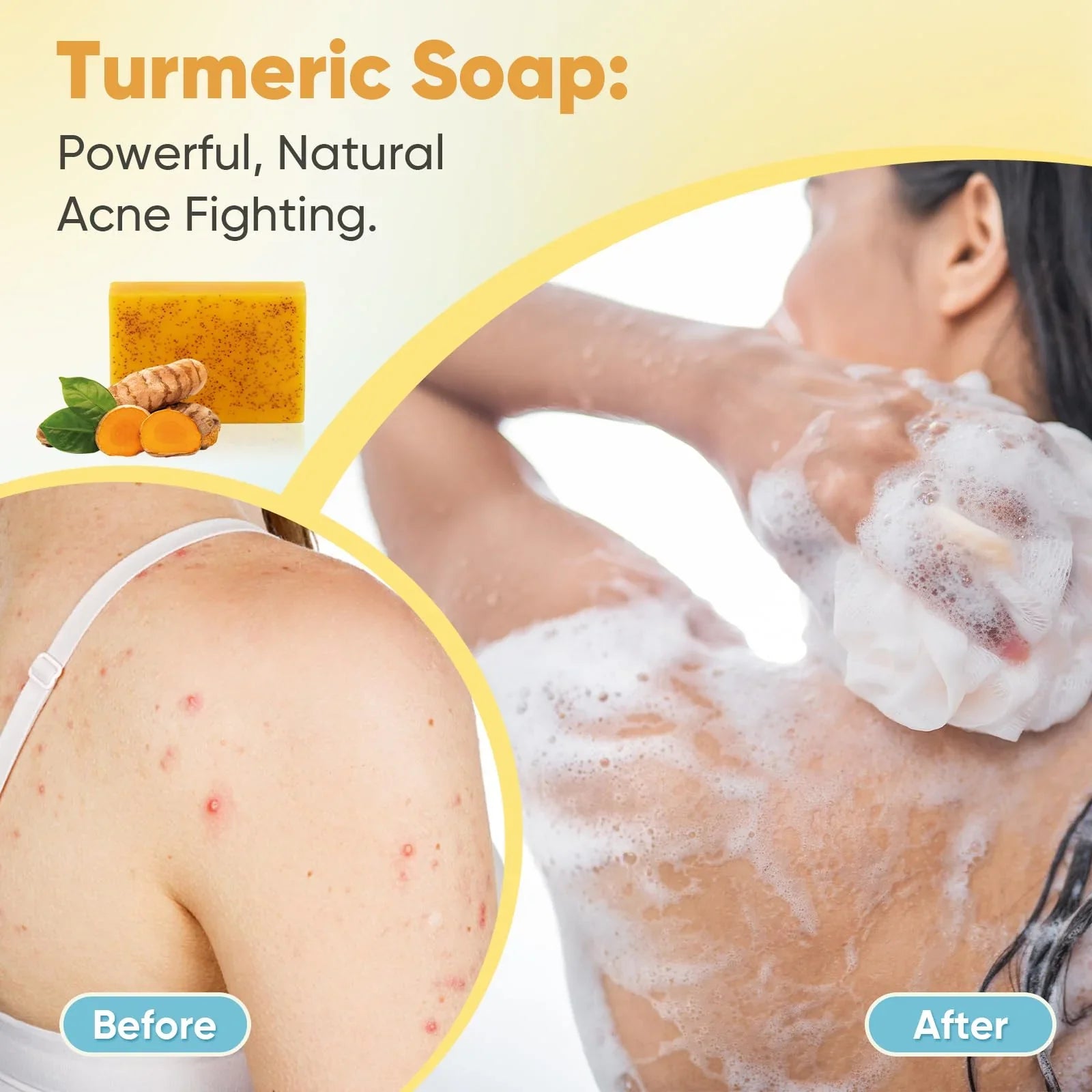 Treeroot Turmeric & Kojic Acid Soap 5-Pack