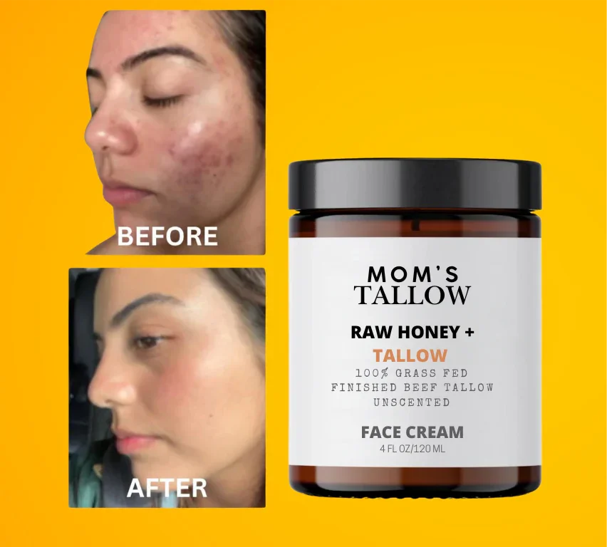 Mom’s Tallow Skin Serenity Face Cream – Nourishing Balm for Sensitive & Flaky Skin