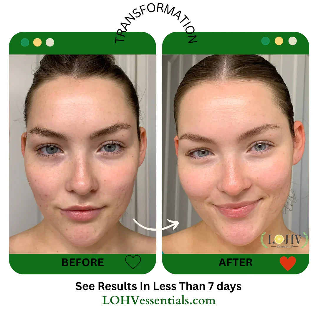 LOHV ESSENTIALS PREMIUM 100% VEGAN HYPER HYDRATOR Face Moisturizer