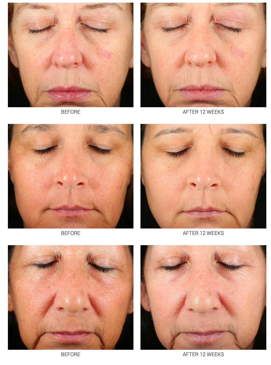 Accelerated Aesthetics Advanced WRI-LAX 5x