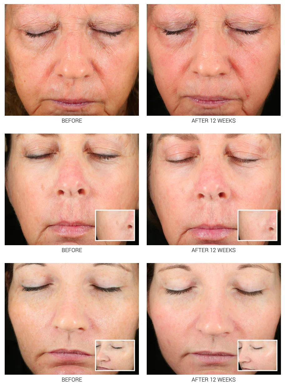 Accelerated Aesthetics Advanced WRI-LAX 5x