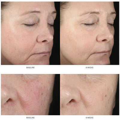 Accelerated Aesthetics Hyaluronic Acid Serum Estimated Return to Stock Date: 1/21/2026 - Image 2