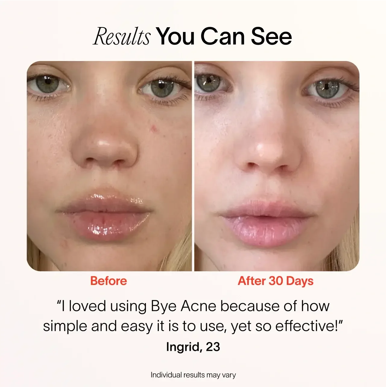 Solawave Bye Acne: 3-Minute Pimple Spot Treatment